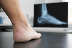 Gros plan sur un talon douloureux évoquant une épine calcanéenne, en cabinet médical